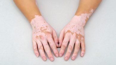 Researchers find hints about the vitiligo mechanism