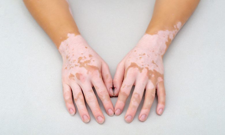 Researchers find hints about the vitiligo mechanism