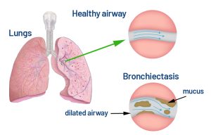 Bronchiectasis