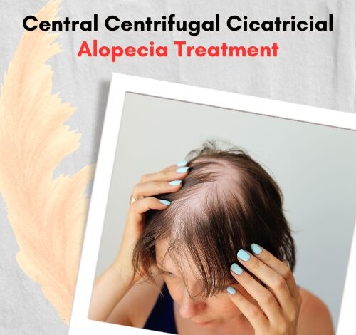 Central Centrifugal Cicatricial Alopecia Treatment (2)