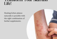 Heal Lichen Planus Naturally