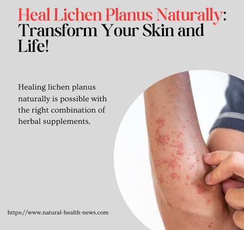 Heal Lichen Planus Naturally