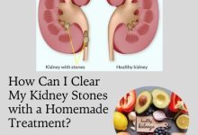 How Can I Clear My Kidney Stones with a Homemade Treatment