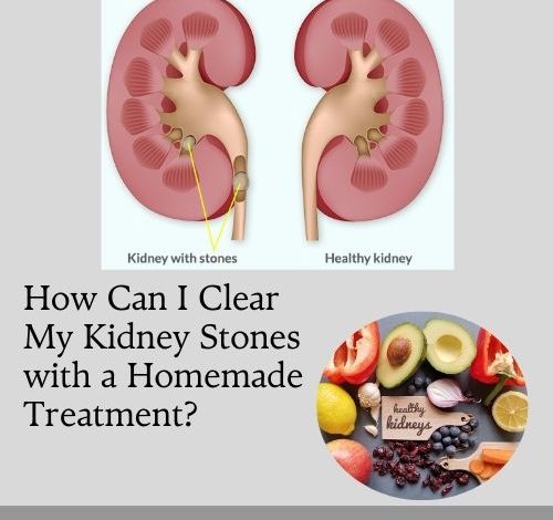 How Can I Clear My Kidney Stones with a Homemade Treatment