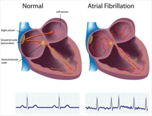 Atrial Fibrillation