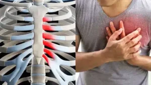 Costochondritis 