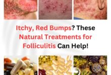 Natural Treatments for Folliculitis