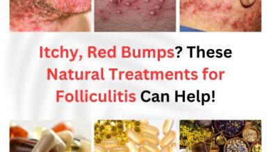 Natural Treatments for Folliculitis