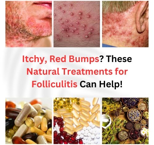 Natural Treatments for Folliculitis